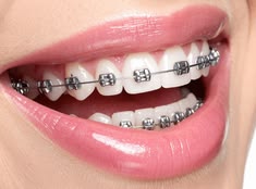 Orthodontic Braces